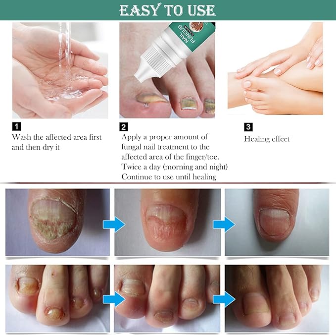 Nexusdrop Nail Fungus Solution