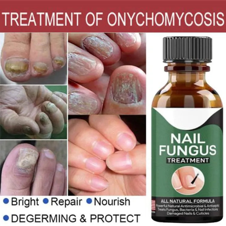 Fast Nail Fungal Treatment